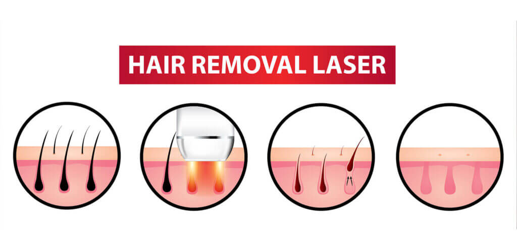 IPL Hair Remover Review